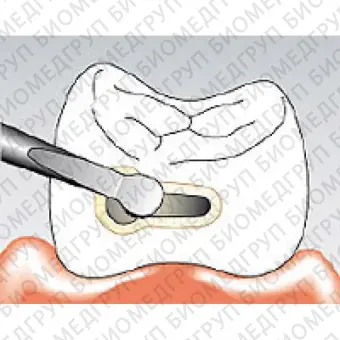 Sonicflex micro 33  насадка для минимально инвазивной терапии кариеса с алмазным покрытием, большая полусфера, мезиальная