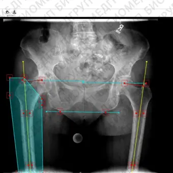 Модуль программного обеспечения для предоперационного планирования mediCAD Web