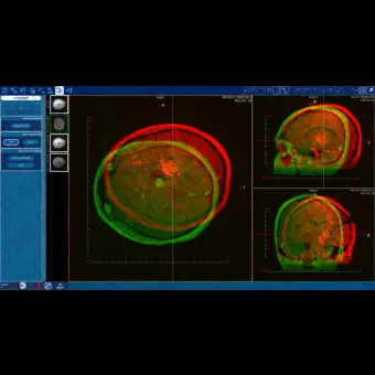 Программное обеспечение для медицинских снимков NeuroBlate  SoftwareTM NeuroBlate 