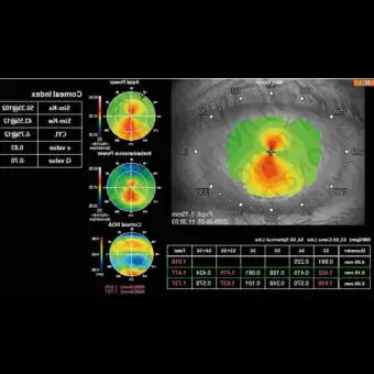 Роговичный топограф KR1W